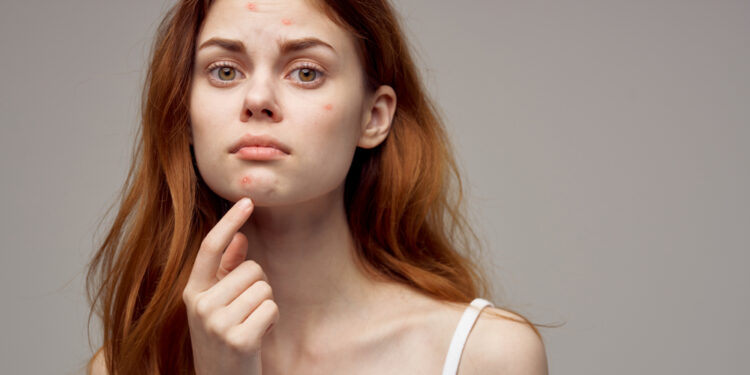 Can pimple stickers help you?