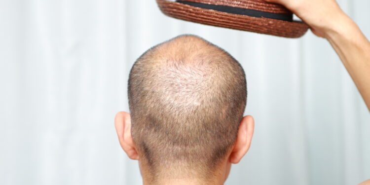 Is it true that wearing hats can make you bald?